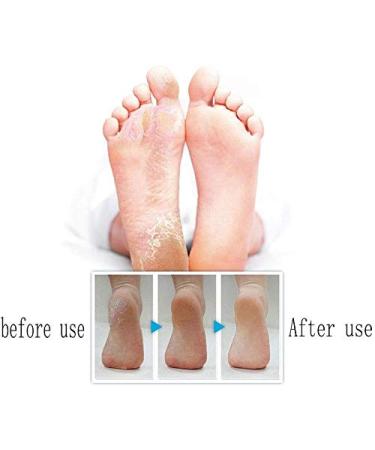 Drybely Professional Pedicure Tool Set - Stainless Steel Cornel Remover & Razor for Hard Skin & Dead Skin Care - 10 Blades for Perfect Foot Maintenance - Buy Online on GoSupps.com