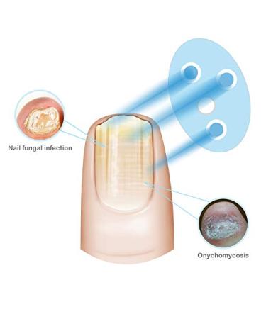 7-Minute Nail Fungus Cleaning Solution for Healthier and More Beautiful Fingernails and Toenails - Say Goodbye to Embarrassing Onychomycosis - Buy Online on GoSupps.com