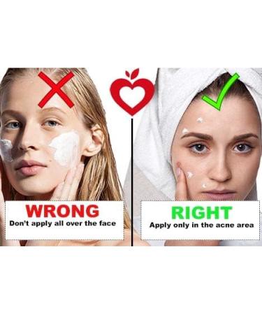 Le Pommiere Acne Treatment Gel 50ml Helps Remove Pimples Acne from Face or Body Anti-Facial and Body Impurities Youth Young Hormonal or Cystic - Buy Online on GoSupps.com