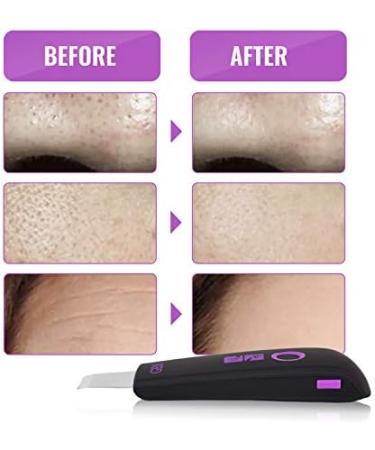 GESS Ultrasonic Facial Cleansing Device | Blackhead Remover & Pore Cleanser | Acne Exfoliator & Skin Care Massager | Rechargeable - Buy Online on GoSupps.com