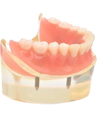 Dental Model Overdenture with 4 Implants - Ideal for Teaching Toothbrushing & Hygiene in Classes - International Shipping Available - Buy Online on GoSupps.com