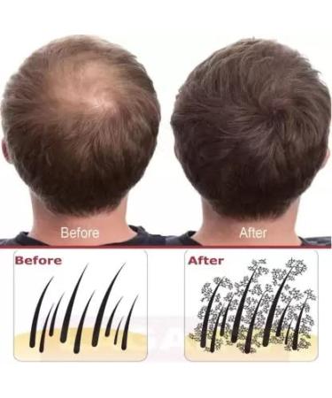 Hair Building Fiber Hair Loss Concealer - Dark Brown (28g) | Instant Volume & Fullness | International Shipping Available - Buy Online on GoSupps.com