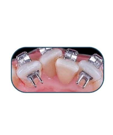 10 pieces Dentalmall Lingual rest Bite Turbos Openner Bondable Hinge Tongue Crib Tongue Tamers - Buy Online on GoSupps.com