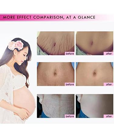 Mango Stretch Marks & Scar Cream (40g) | Pregnancy & Obesity Scar Removal - Wrinkle Reduction & Moisturizing - Buy Online on GoSupps.com