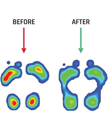 Insoles with Metatarsal Foot Pads | Ball of Foot Pain Relief | Arch Support Orthotics for Men & Women | Size 6-6.5 US / 8-8.5 US - Buy Online on GoSupps.com