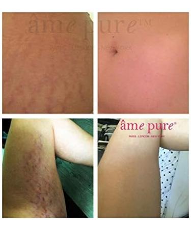 Ame Pure Microneedling Roller - Micro Needling Roller For Stretch Marks Scars And Cellulite! - Durable Derma Roller 0.75 mm - Laser Treatment Alternative - Glow & Thrive: Revitalize Your Skin Today! - Buy Online on GoSupps.com