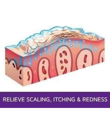 Psoriasis Treatment Gel - Advanced Relief for Flaking & Irritation - Hydrating Soothing Non-Greasy Formula - Fast-Absorbing 2 oz | International Shipping Available - Buy Online on GoSupps.com