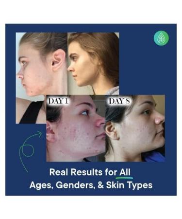 Soothing Facial Lotion | Calming Night Cream for Blemishes & Breakouts | Gentle Vegan Formula | 90 Day Supply - 3 oz - Fragrance & Cruelty Free - Buy Online on GoSupps.com