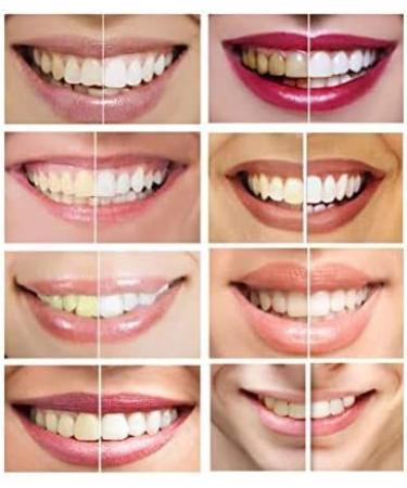 44% Carbamide Peroxide Teeth Whitening Gel Syringe | 10 Ml (Pack of 10) | Includes Mouth Trays - Buy Online on GoSupps.com