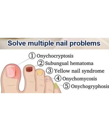 Nailrox Cream 30g Effective fungal nail treatment Nail Repair cream Nail fungus treatment for toenail ingrown toenail treatment - Buy Online on GoSupps.com