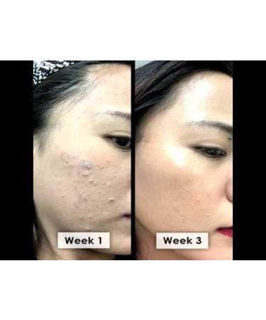 Activated Charcoal Soap: Face and Body Bar for Natural Treatment of Acne Psoriasis Body Odor and Excessive Oil - Organic Vegan Skin Care - Buy Online on GoSupps.com