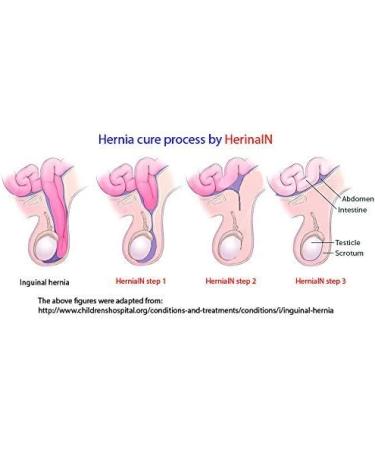 HerniaIN 3 Pack-NO Surgery NO Belt NO Tablet Essential Oil Blend Easy to Apply Tested for 50+ Years Natural Remedy for Hernias of Child Under 12 Try it for 1-2 Weeks Before Seeing a Doctor - Buy Online on GoSupps.com
