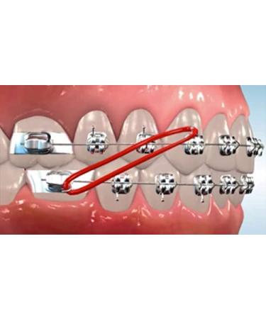 SmileSupplies Orthodontic Colour Elastic for Braces - Pack of 100 + Free Placer | Fix Tooth Gaps - 3/16" - 3.5 Oz - Buy Online on GoSupps.com
