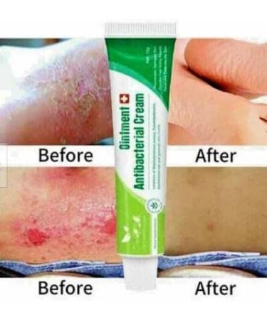 Herbal Anti-Itch Eczema Relief Ointment for Skin Rash Treatment - Buy Online on GoSupps.com
