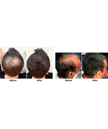 PROPIDEX Premium Hair Regrowth Treatment for Men & Women | Biotin & Saw Palmetto Formula to Prevent Hair Loss & Stimulate Follicles - Buy Online on GoSupps.com