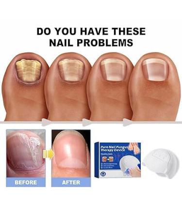Furzero Purenail Laser Therapy Device | Effective Nail Fungus Treatment & Light Therapy for Healthy Nails - Buy Online on GoSupps.com