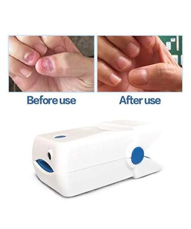 MAGNETOE Portable Nail Therapy Device | October 2021 Edition for Toes & Fingernails - Buy Online on GoSupps.com