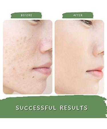 ORGANIZE Green Coffee Blemish Clear Anti Pigmentation and Dark Spot Removal Cream Mulberry Apple cider vinegar Vitamin C Ayurvedic Formulation 50GM - Buy Online on GoSupps.com