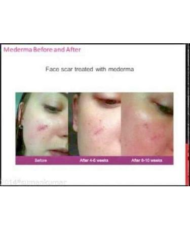 Mederma Ayurvedic Cream for Scars, Surgery, Injury, Burns, Acne & Cut Marks - 10g - Buy Online on GoSupps.com