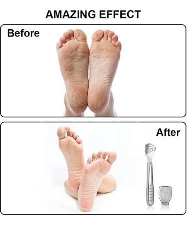 Luoileily Pedicure Foot Rasp & Callus Shaving Kit - 20 Blades Professional Foot Care Scraper for Dead Skin & Hard Skin Remover - Buy Online on GoSupps.com