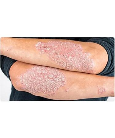 Natural Cream For Skin Healing Burns Sunstrokes Insect Bites Eczema - Buy Online on GoSupps.com