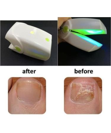 Buy Sell Trade Nail Fungus Laser Treatment - Effective Home Cure for Onychomycosis & Fungal Infections - Buy Online on GoSupps.com