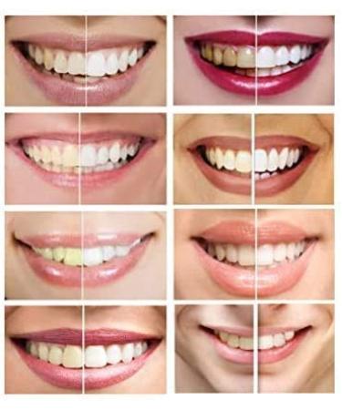 White Teeth Global 10 Syringes (3ml) - Strongest 44% Carbamide Peroxide Gel - Buy Online on GoSupps.com