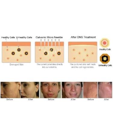 Dns Derma Skin Roller For Winkles & Scars (1.0mm) - Buy Online on GoSupps.com