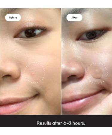 Buy Premium Acne Pads 36ct - ZitBeGone for Effective Acne Treatment | International Shipping Available - Buy Online on GoSupps.com