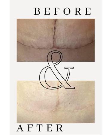 Scar Erase Silicone Scar Sheet Treatment - Soften & Flatten Surgery, Injury, Burns + C-Section Scars - 6 Week Medical Grade Strips (3cm x 15cm) - Buy Online on GoSupps.com