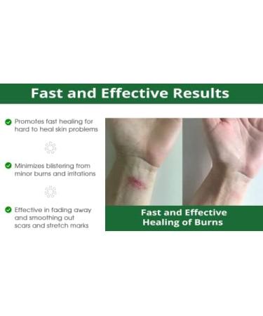 Dermalere Advanced Burn and Scar Cream - Fast Healing Face and Body Treatment - Scar Removal for Old & New Scars - Burns, Sunburns, Injuries & Surgery - Skin Irritation Relief - 1.35 oz - Buy Online on GoSupps.com