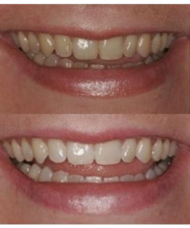 ProDental Teeth Whitening Gel Syringe Refill 10 Pack | 35% Carbamide Peroxide | 60 Treatments | Fast Results | Safe for Sensitive Teeth - Buy Online on GoSupps.com