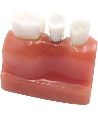 4x Dental Implant Teeth Model with Removable Crown - Crown & Bridge Dentist Training Tool for Patient Analysis | International Shipping - Buy Online on GoSupps.com