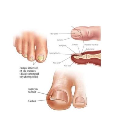 Buy Sell Trade Nail Fungus Laser Treatment - Effective Home Cure for Onychomycosis & Fungal Infections - Buy Online on GoSupps.com
