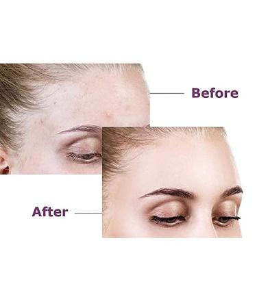 Acne Hydrocolloid Patch Spot Treatment - Fast-Acting Vegan & Cruelty-Free 36 Patches for Face & Body - Buy Online on GoSupps.com