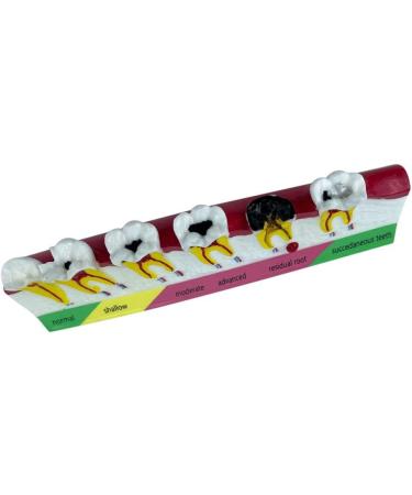 LEYTON Tooth Model for Dental Teaching | Caries Model Enhance Understanding of Pathological Processes | International Shipping Available - Buy Online on GoSupps.com