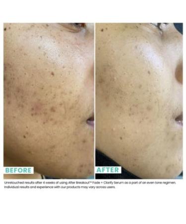 Urban Skin Rx After Breakout Fade + Clarify Serum | Fades Acne Scars & Dark Spots | Vegan & Cruelty-Free Skincare for All Skin Types | 1 Fl Oz - Buy Online on GoSupps.com