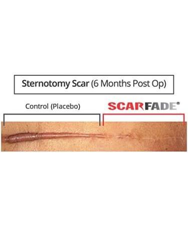 Surgery & Burn Scar Ointment 2 Oz - Speed up Healing & Reduce Scarring - Buy Online on GoSupps.com