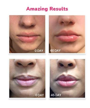 LifeCell Lip Plumping Treatment - Fuller, Smoother Lips | Buy Online - Buy Online on GoSupps.com