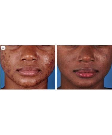 Zo Skin Health Oil Control Pads Acne Treatment 60 Pads/Tampons - Buy Online on GoSupps.com