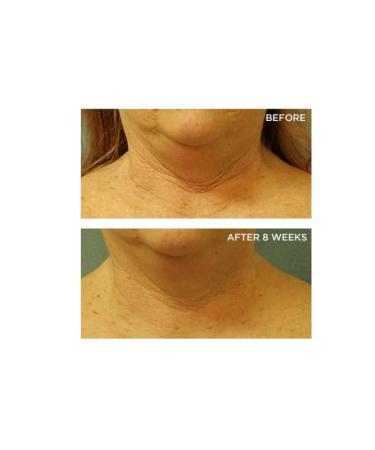 Perricone MD Cold Plasma Plus+ Neck & Chest Broad Spectrum SPF 25 | Anti-Aging Skincare - 2 fl. oz. - International Shipping Available - Buy Online on GoSupps.com