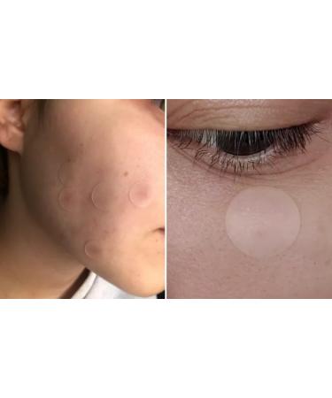 Hydrocolloid Acne Patch with Salicylic Acid - Fast Healing for Pimples | 72 Patches in 2 Sizes | International Shipping Available - Buy Online on GoSupps.com