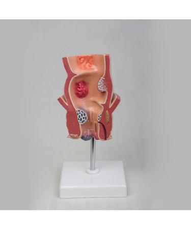 ZCBYBT Hemorrhoid Injury Model Human Rectal Pathology Model Internal and External Hemorrhoids Model Anus Model Suitable for Educational Use - Buy Online on GoSupps.com