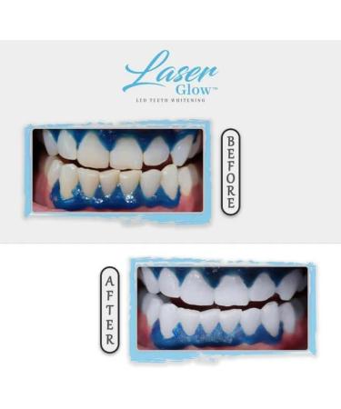 LaserGlow Gum Protector - Teeth Whitening Essence Pen - Gentle Comfortable and Easy-to-Use Perfect for Gums and Teeth Health - Buy Online on GoSupps.com