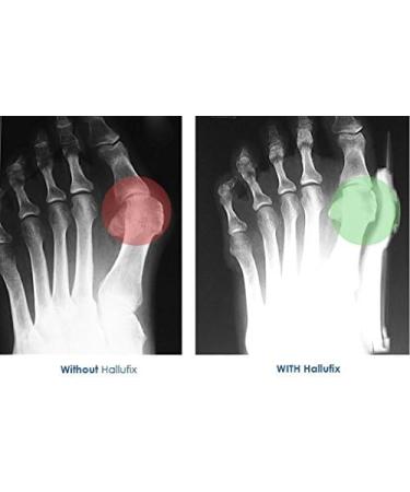 Days Homecraft Hallufix Bunion Splint - Comfortable & Effective Relief for Bunion Pain | International Shipping Available - Buy Online on GoSupps.com