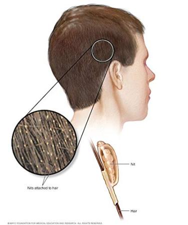 Chemical-Free Lice Comb Treatment with Double Spiral Micro Grooved Teeth - Buy Online on GoSupps.com