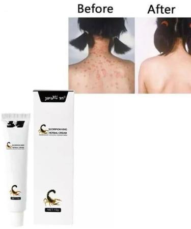 Skin Allergy Cream for Athlete's Foot, Jock Itch, Mosquito Bites & Fungus - Buy Online on GoSupps.com