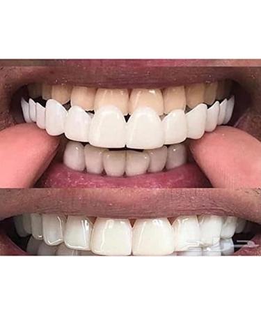 Silicone Gel Perfect Smile Braces - Teeth Socket Whitening Alternative - Buy Online on GoSupps.com