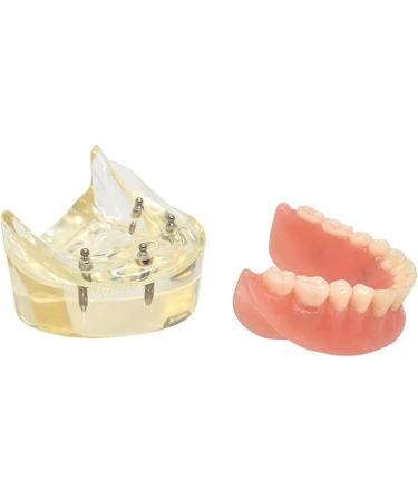 Dental Model Overdenture with 4 Implants - Ideal for Teaching Toothbrushing & Hygiene in Classes - International Shipping Available - Buy Online on GoSupps.com