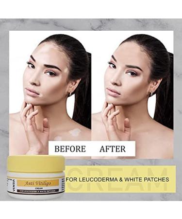 MIYUU Anti Vitiligo Cream | Effective Treatment for Vitiligo White Patches & Skin Discoloration | Scar Removal | 80g - Buy Online on GoSupps.com
